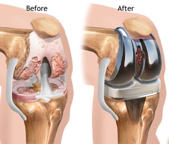 Knee Replacement